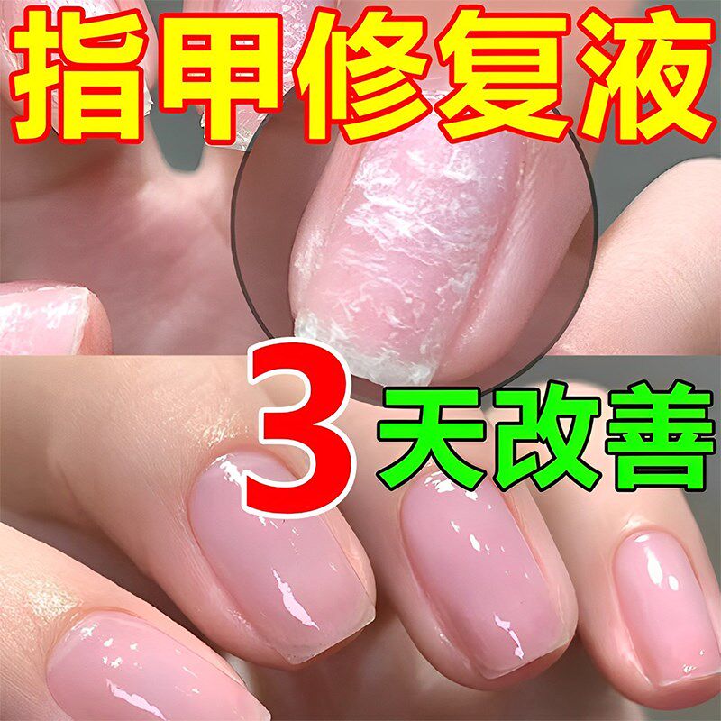 指甲薄软修复防断裂增厚受损甲床甲肉分离竖纹营养液分层护甲再生