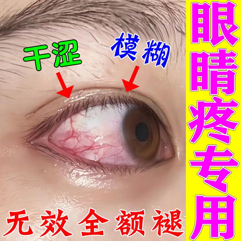 眼睛疼起红血丝用眼过度熬夜眼睛干涩看东西模糊去除红血丝眼水