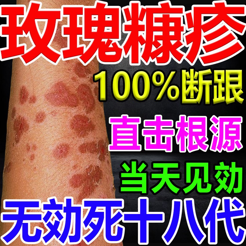 玫瑰糠疹专用膏药除糠疹根日光性皮紫外线过敏晒伤脂溢性炎止瘙膏