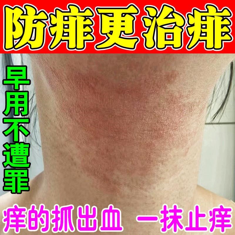 痱子专用止痒去痱药膏成人去痱子软膏大人额头上脖颈长痱子红瘙痒