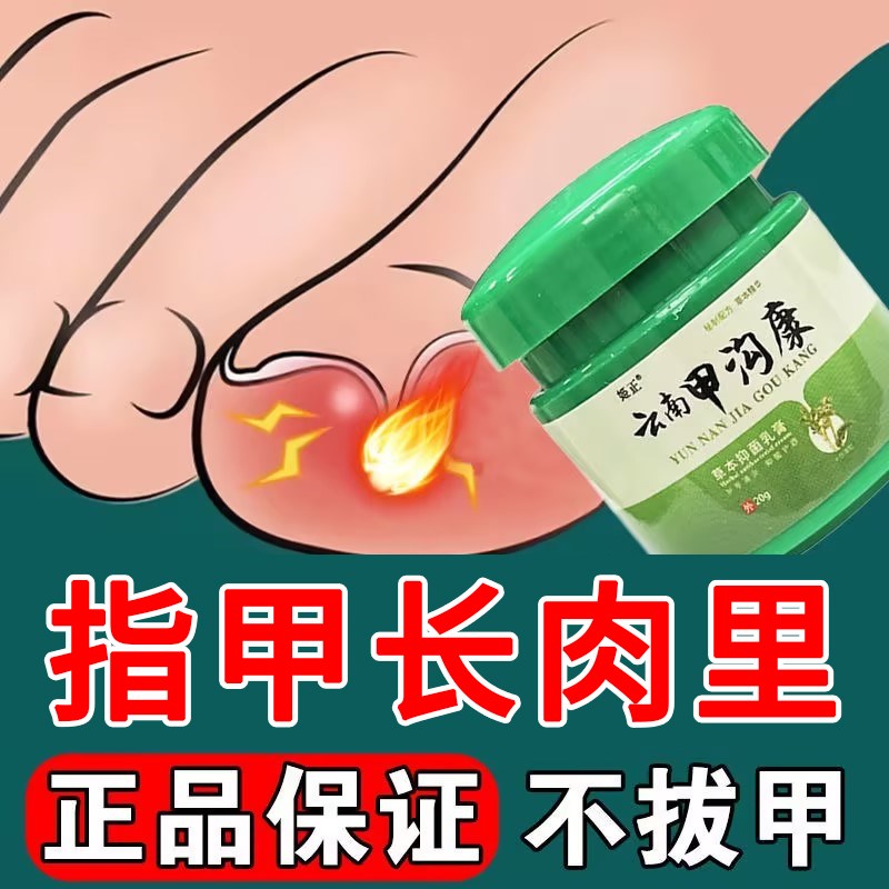 去嵌甲型甲沟焱息肉甲勾脚指甲往肉里长去肉牙甲沟红疼膏指甲软化
