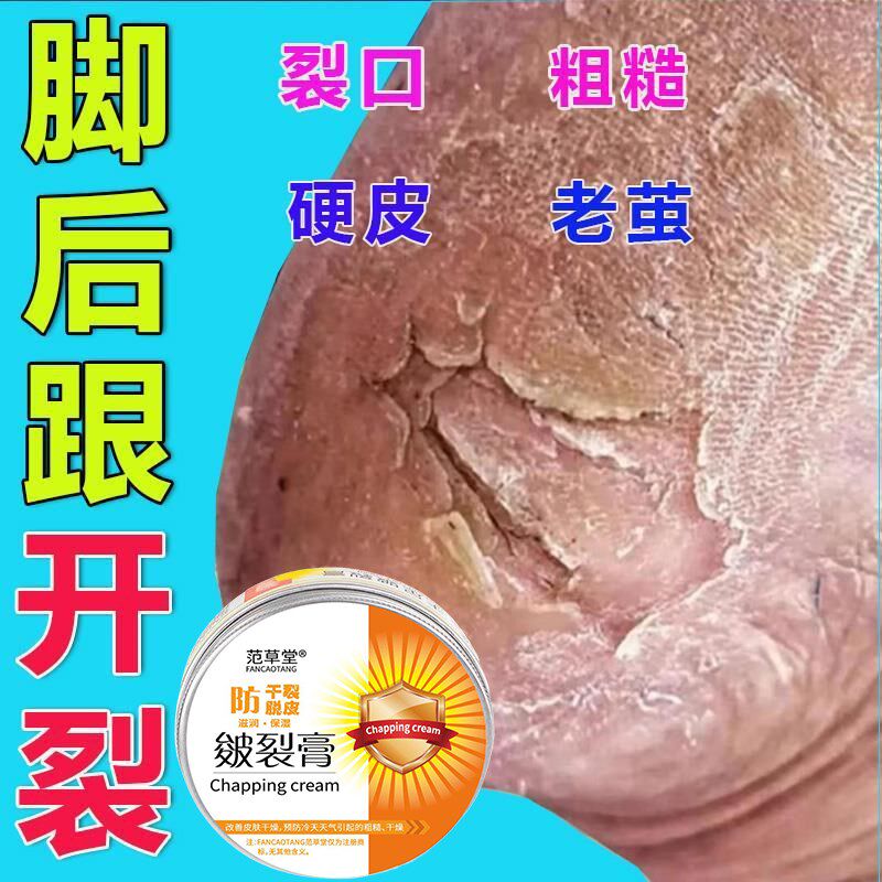 脚后跟干裂修覆霜皱皴龟裂马油防开裂愈合膏手足裂口脚跟脚底皲裂