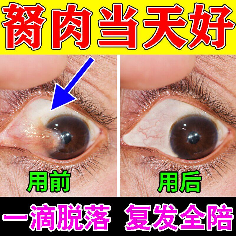 除眼睛胬肉滴眼液翼状玻璃体混浊看不清楚血丝有异物红干痒水