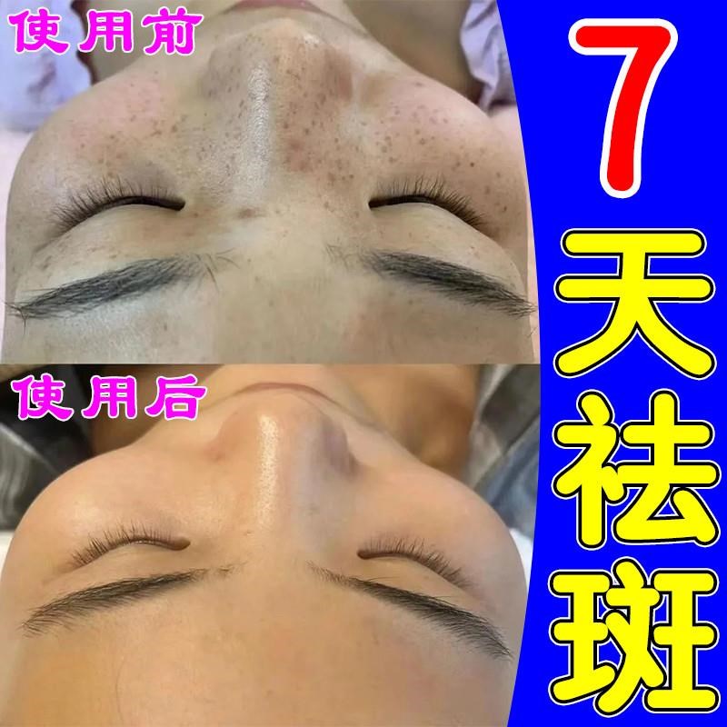 【7天去除祛斑霜祛黄褐斑晒斑治老年斑的药膏一擦就掉淡化黑色素