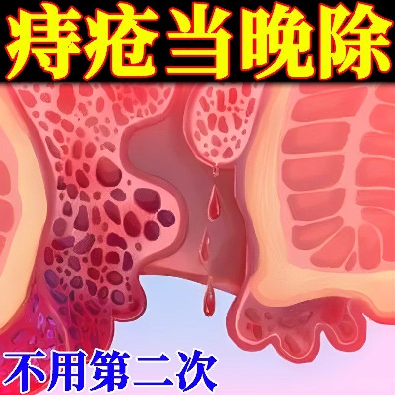 【有痔青年 已成功拯救60万人疮】内外混合痔 温和祛肉球 买2送1