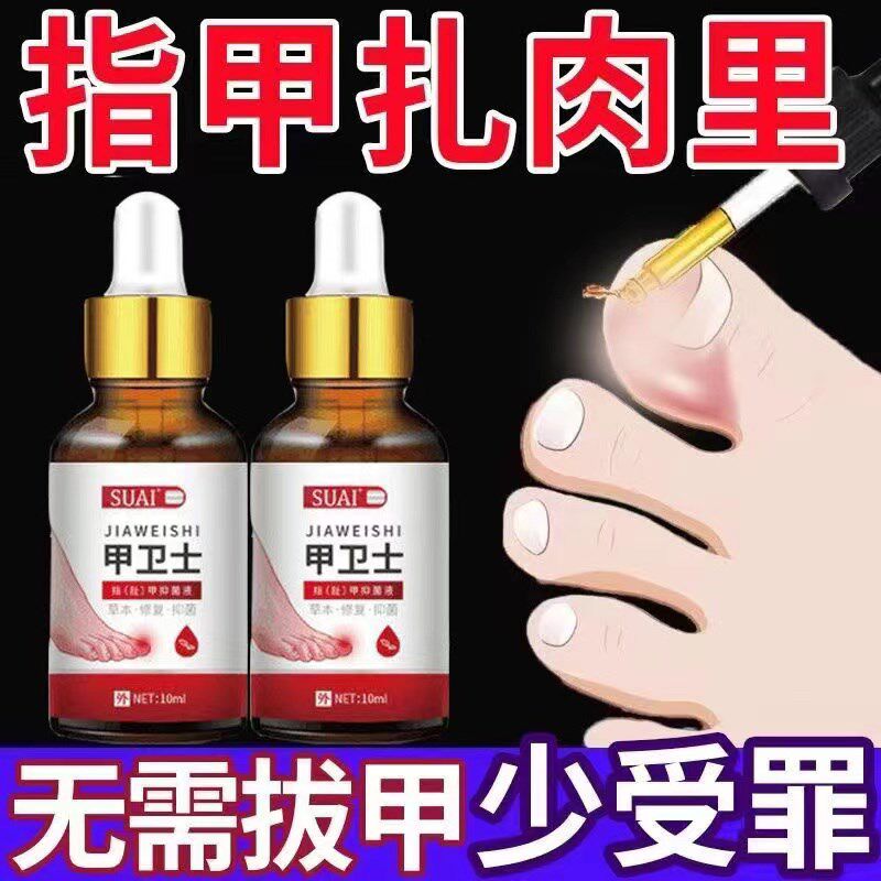 【严重甲沟炎专用】去肉芽脚趾甲往肉里长嵌甲红肿疼痛化脓抑菌液