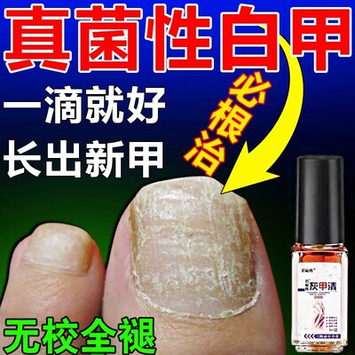 真菌性白甲脚指甲盖变厚发黄增厚趾甲变硬空灰甲床分离修覆好变坏