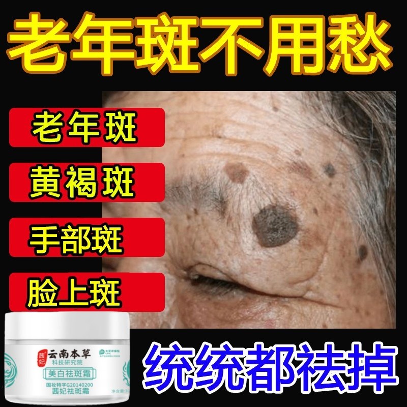 老年斑强力去除手上脸部去斑霜去班专用斑祛霜祛黄褐斑女男士正品