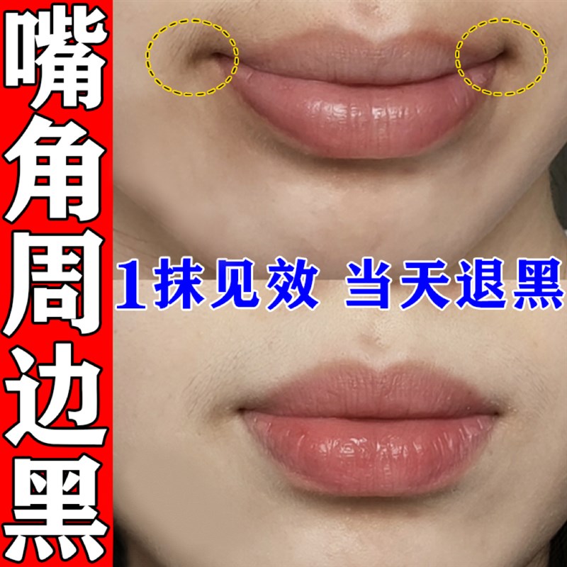 嘴角发黑去除嘴巴周边黑淡化唇色唇纹暗沉去除黑色素沉淀专用唇膜