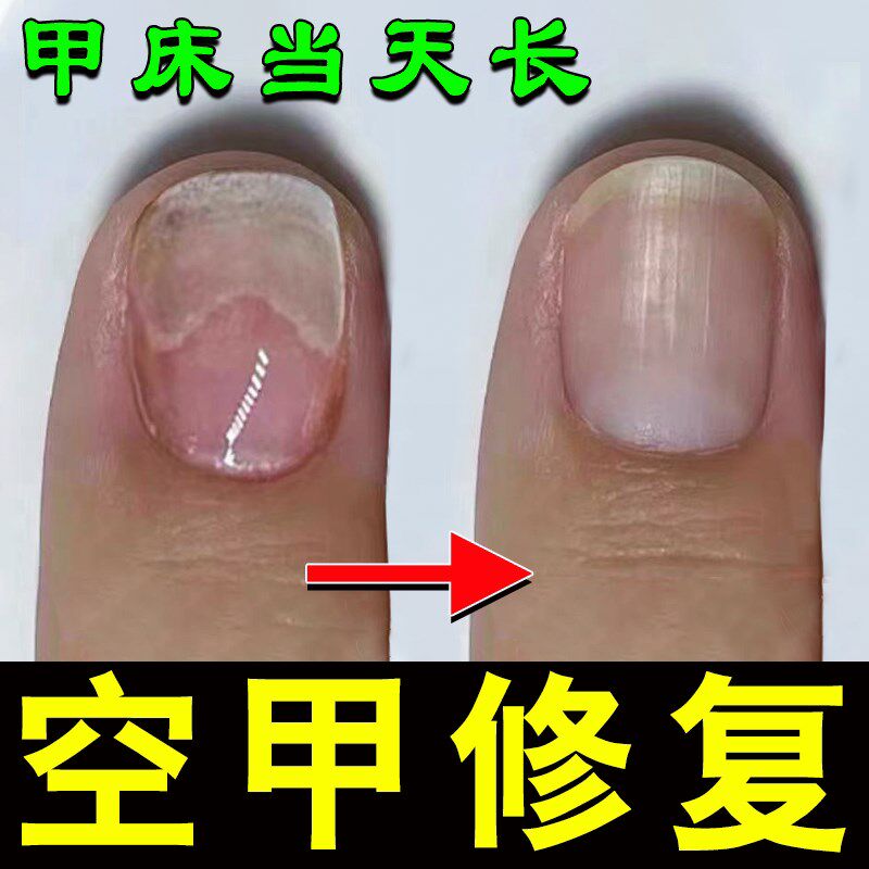 空甲修复甲肉甲床分离专用指甲竖纹分层开裂受损再生指甲床增长液