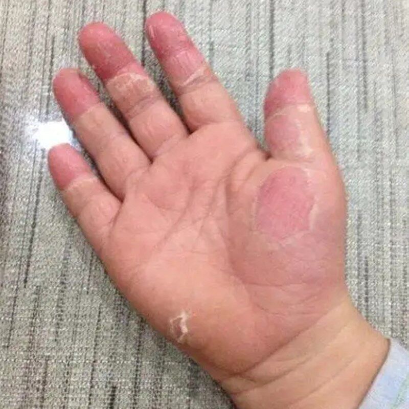 手痒脱皮干裂手气膏手上起小水泡膏手气痒脚底板脱皮膏2送1