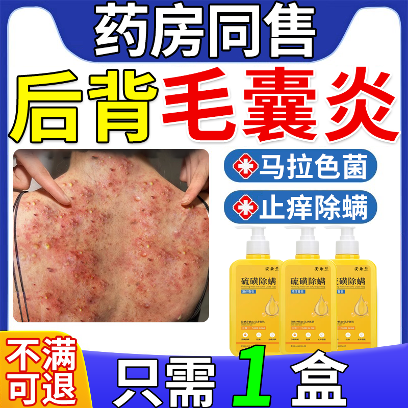 【毛囊炎专用】沐浴露