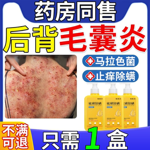 治后背长痘痘毛囊炎疗专用二硫化硒洗剂药膏马拉色菌特效沐浴露FF