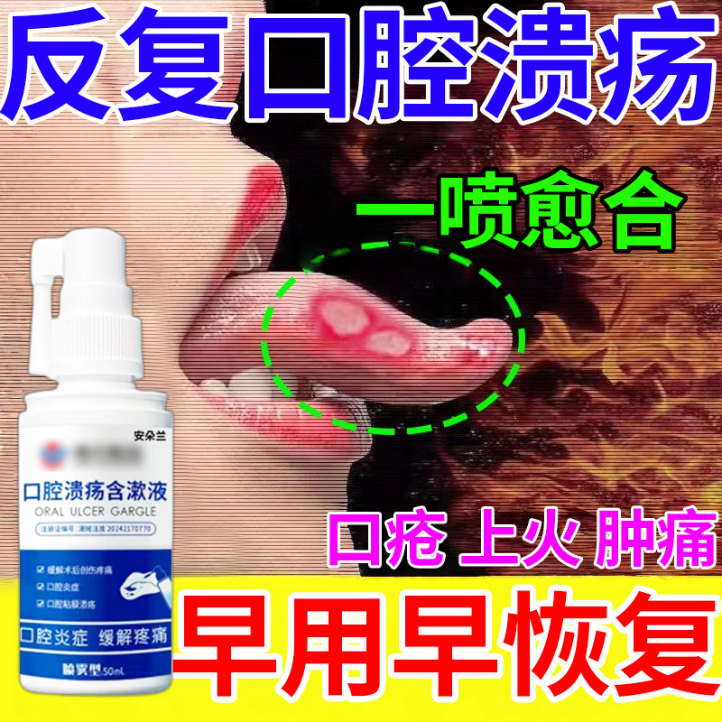 口腔溃疡反反复复【口舌生疮