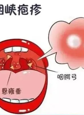 小儿PZX咽峡炎贴敷(2贴)