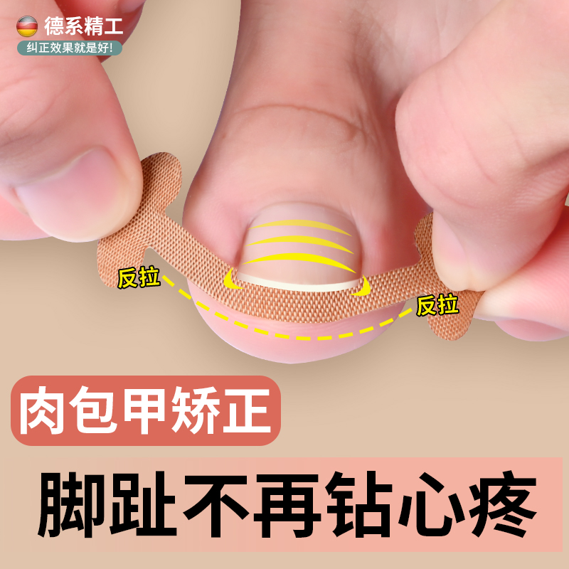 甲沟矫正器肉包甲嵌甲纠正神器指甲专用矫正贴脚趾甲沟隔离正甲片