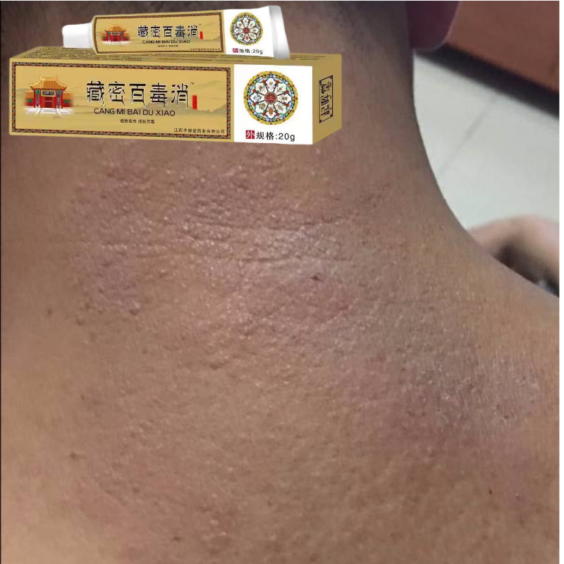 脖子长痘痘疙瘩日光性皮炎紫外线过敏发红泛红脖子湿疹脖子红痒