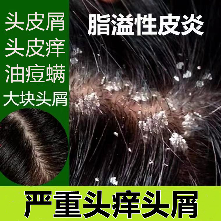 治头部癣去头皮癣屑脂溢性皮炎头皮病止痒去屑软膏洗发水