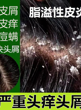 治头部癣去头皮癣屑脂溢性皮炎头皮病止痒去屑软膏洗发水