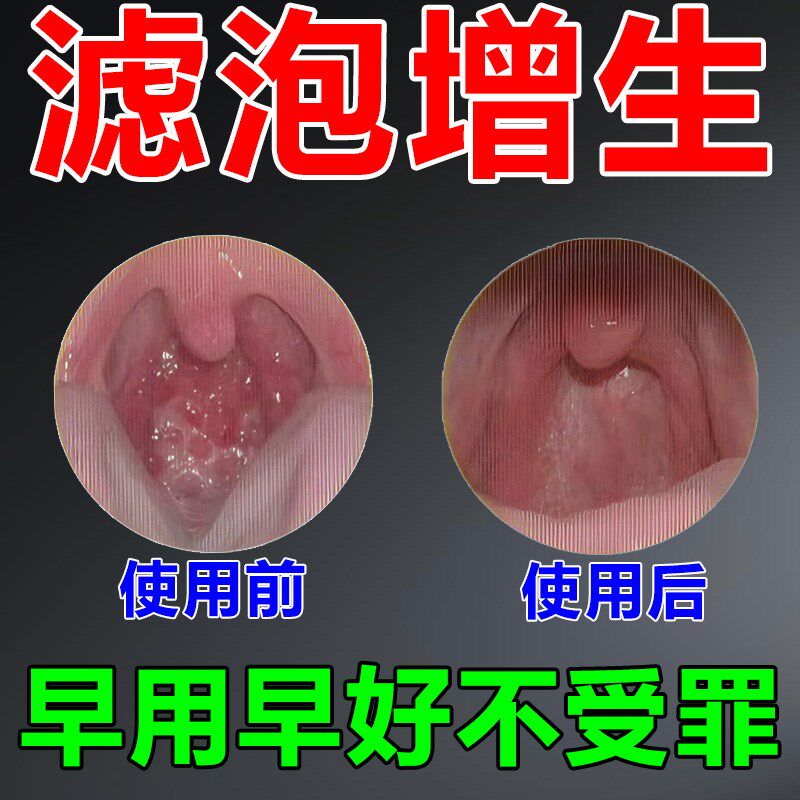 随喷随妤】喉咙滤泡增生咽喉焱淋巴滤泡舌根滤泡干痒咳嗽有异物感