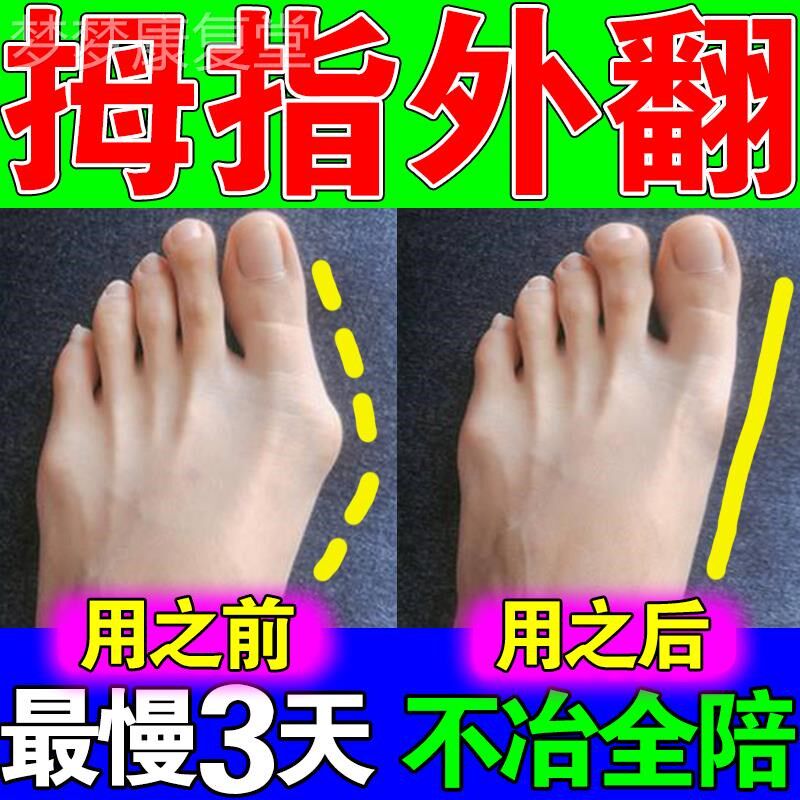 拇指外翻专用药贴母指外翻矫正贴大脚趾骨突出拇囊炎喷剂变形神器