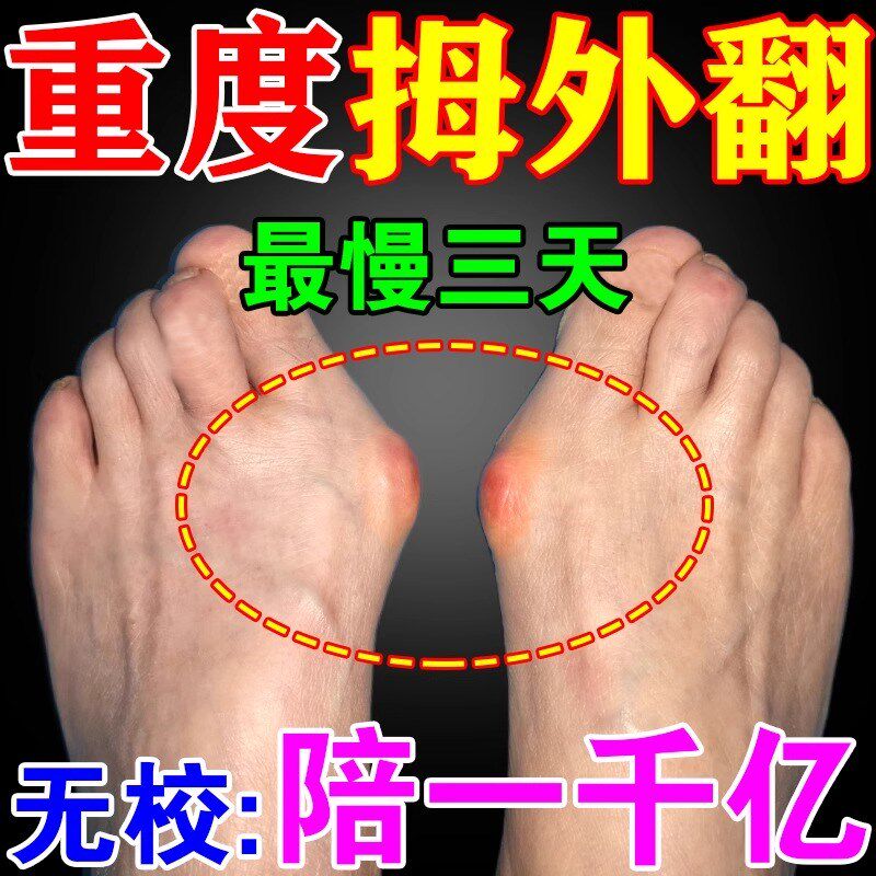 大脚趾拇指外翻膏药贴大脚趾关节畸形疼痛拇囊炎大脚骨专用矫正贴