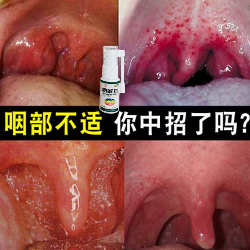 咽喉爽喷剂嗓子发炎干痒肿痛喉咙有痰异物感滤泡炎