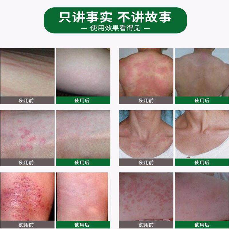全身上干糙脱皮瘙痒起红疙瘩长痘痘前胸背部皮肤过敏
