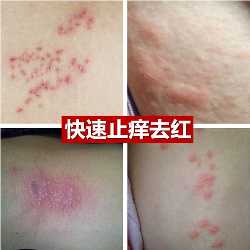 季节性身上痒全身干痒干燥脱皮起红疙瘩外用药皮肤