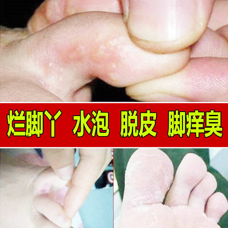去脚気真菌喷雾脚痒脱皮烂脚水泡