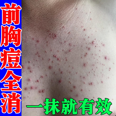 祥医堂胸前痘痘毛囊炎膏