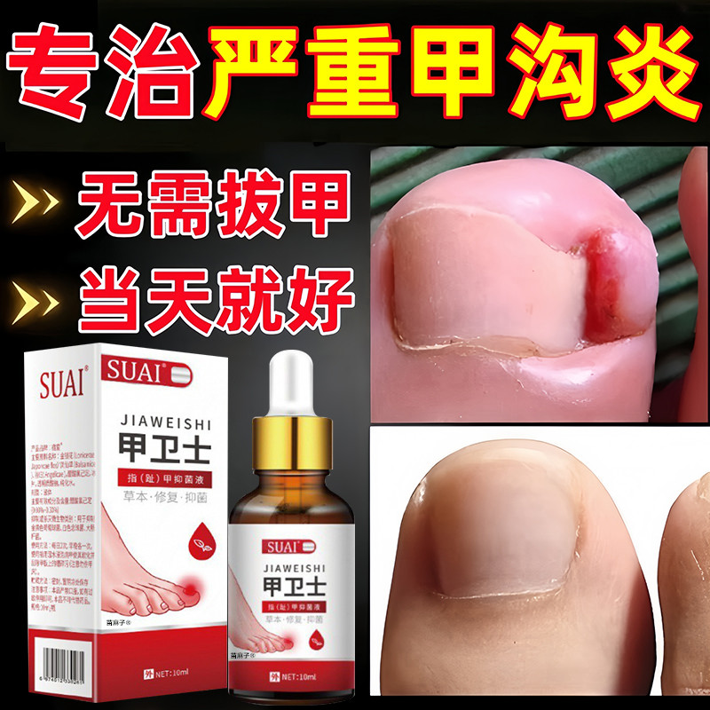 甲沟炎治专用特效膏药脚趾大拇指甲沟炎矫正神器息肉去除软化剂疗
