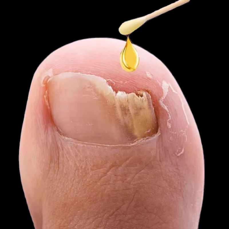 不包不修，轻松去灰指甲