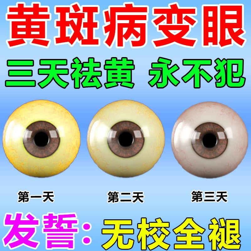 去除眼底黄斑病变眼药水眼睛发黄混浊眼白出血眼球干涩发痒叶黄素