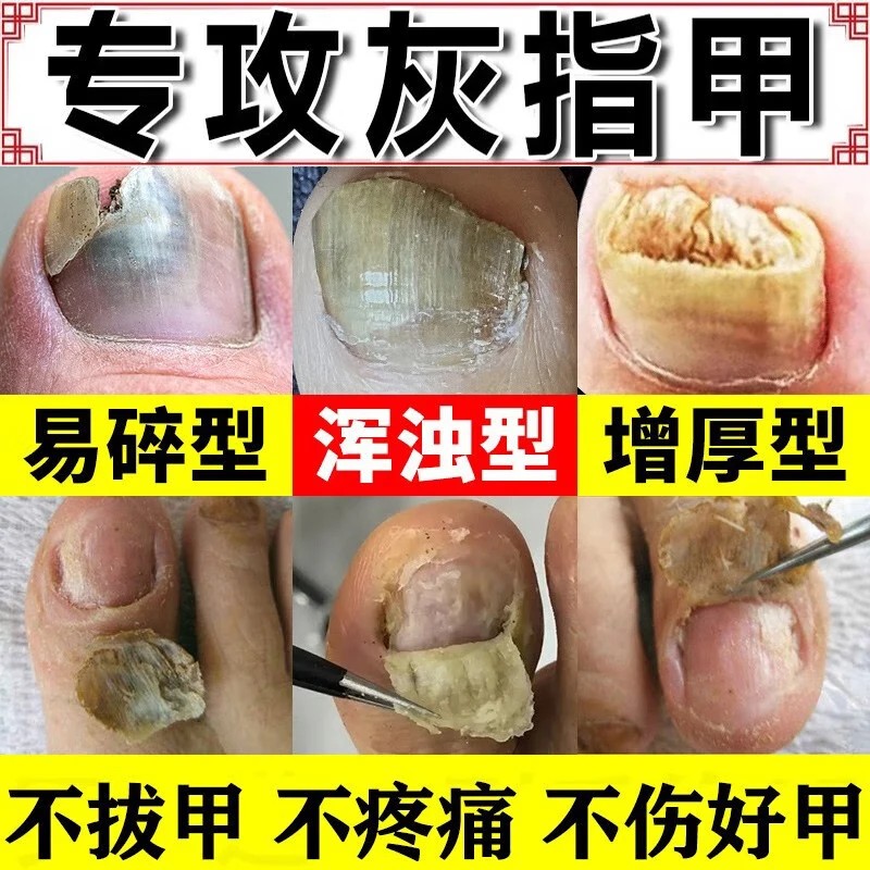 【美国进口】800%专治灰指甲液!