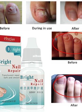 Good Result Chinese Herbal Nail Fungus Treatment Cream Onych