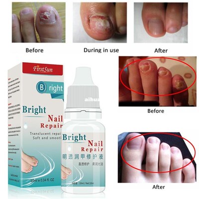 Good Result Chinese Herbal Nail Fungus Treatment Cream Onych