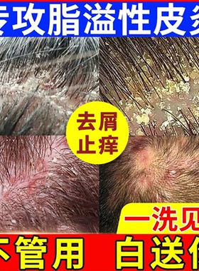脂溢性皮炎囊毛炎洗去屑痒止抑菌头皮屑发水专用医中草药洗发用液