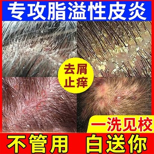 脂溢性皮炎囊毛炎洗去屑痒止抑菌头皮屑发水专用医中草药洗发用液