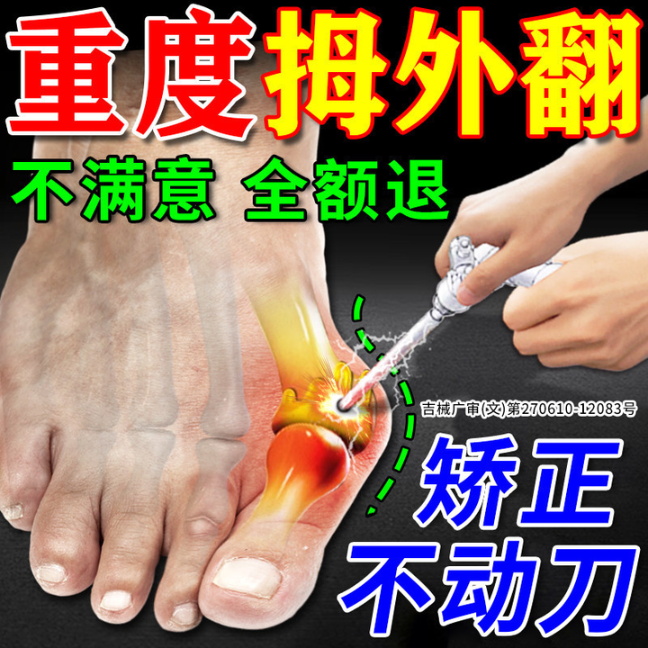 拇指外翻膏药贴矫正大脚骨拇囊炎关节炎药贴拇指器关节疼痛