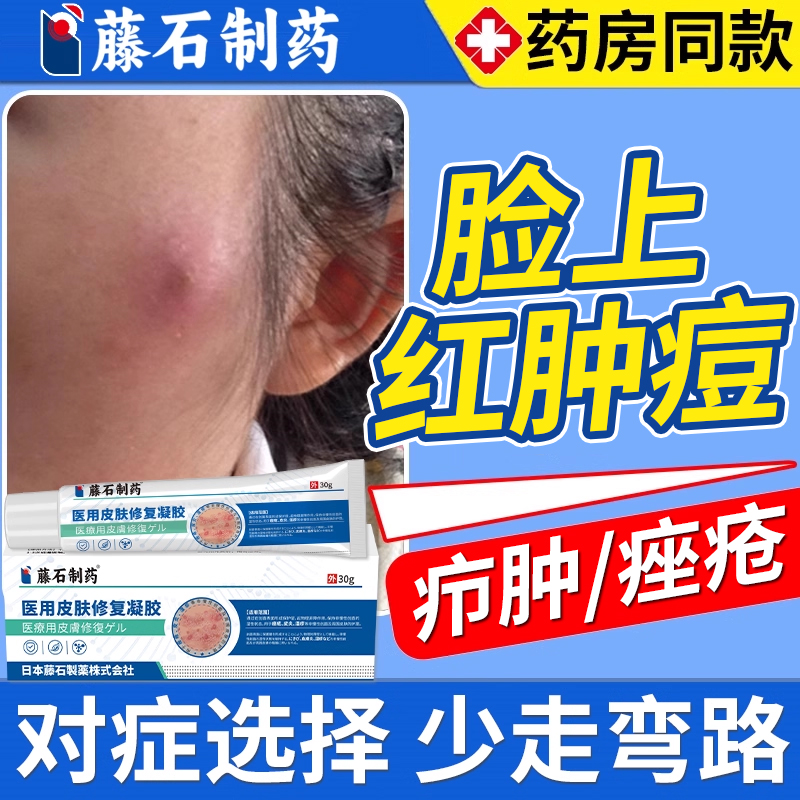藤石制药脸上结节红肿硬疙瘩