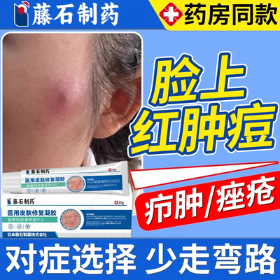 藤石制药脸上结节红肿硬疙瘩