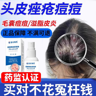 头皮毛囊炎溢脂性皮炎硬疙瘩真菌感染喷雾剂马拉色菌头癣头部HT