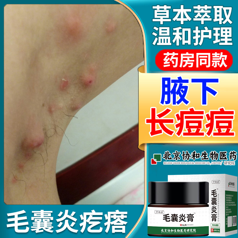 腋下脓包型痘痘硬疙瘩腋窝毛囊炎长疙瘩痤疮按压疼痛可搭配药膏wq