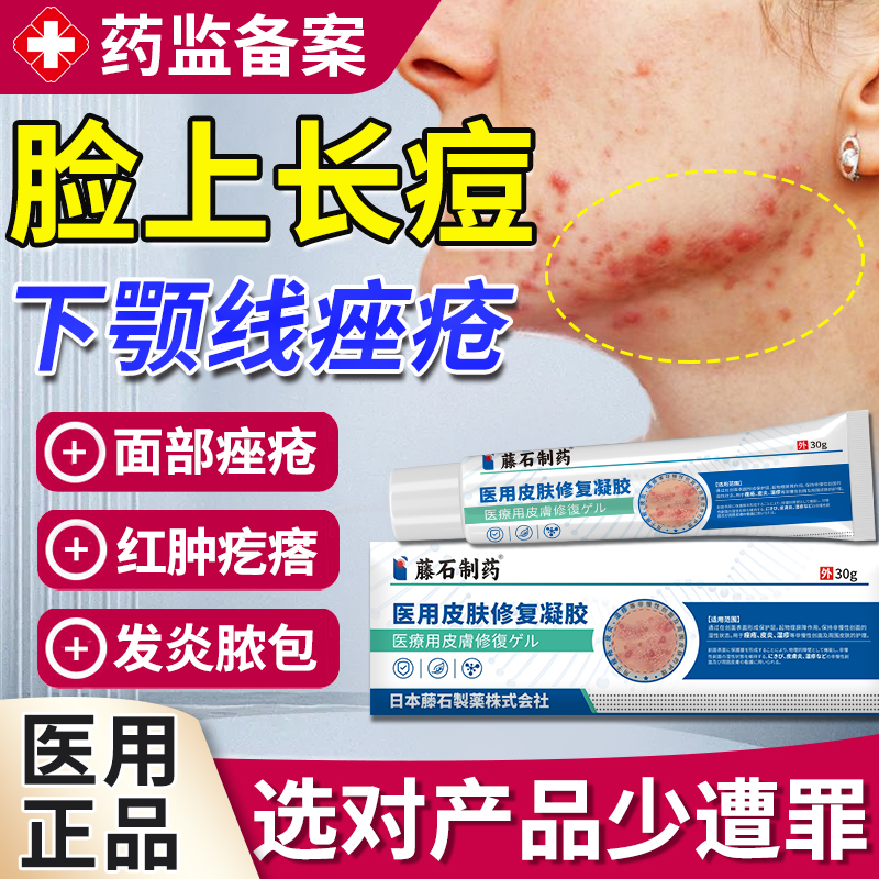 下颚线腮边长痘痤疮药房同售