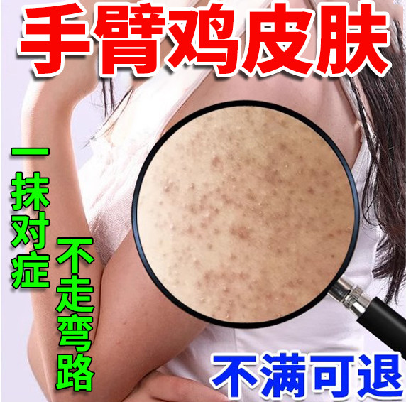 手臂胳膊腿上鸡皮肤毛囊角化毛孔堵塞疏通有鸡皮小疙瘩去除神器vq