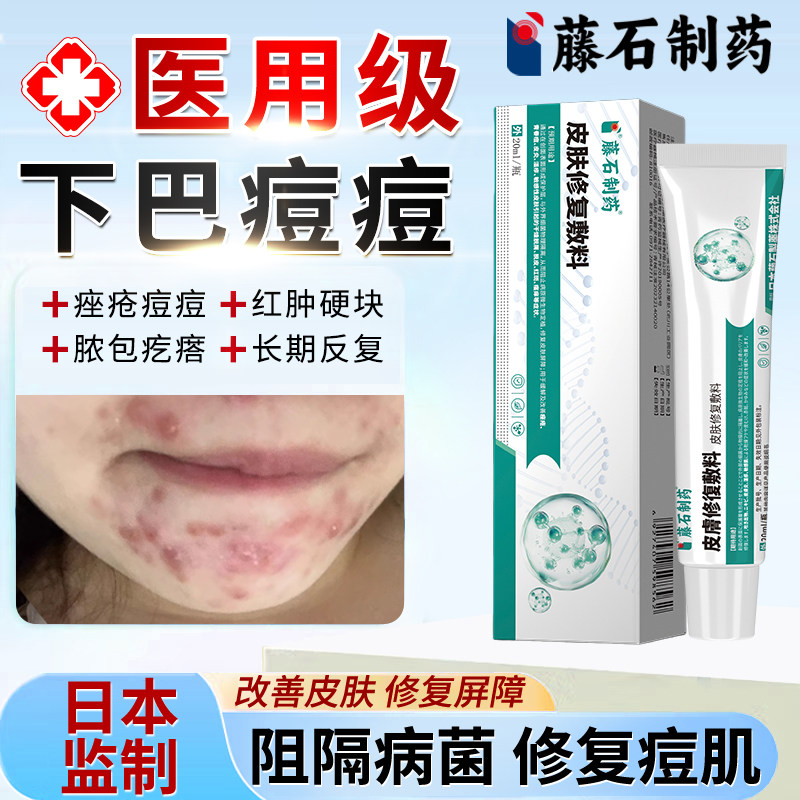 下巴反复长硬块痘痘专用淋巴痘腮边痘粉刺玫瑰痤疮软膏药房同款YZ