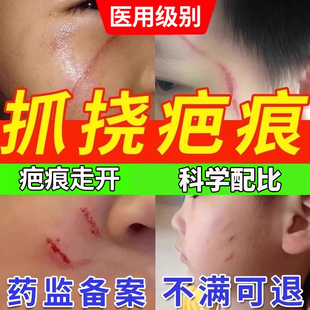 指甲抓伤疤痕修复除疤膏去祛疤儿童专用抓痕脸部淡疤猫狗宠物HT
