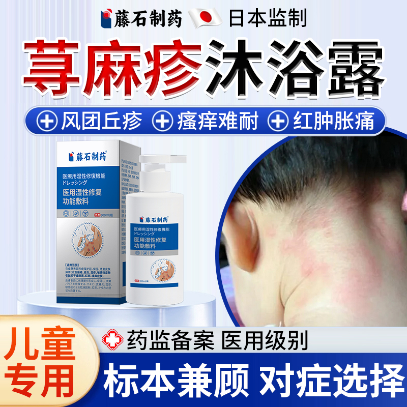 儿童荨麻疹丘疹性慢性止痒沐浴露