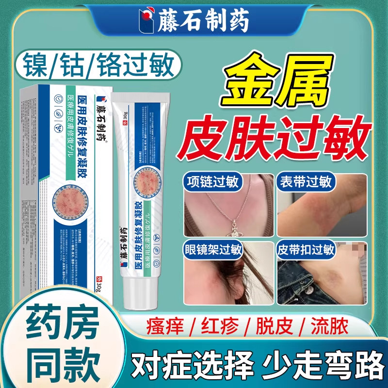 皮肤金属过敏瘙痒红斑丘疹项链手表皮带扣脱皮止痒膏接触性皮炎WQ